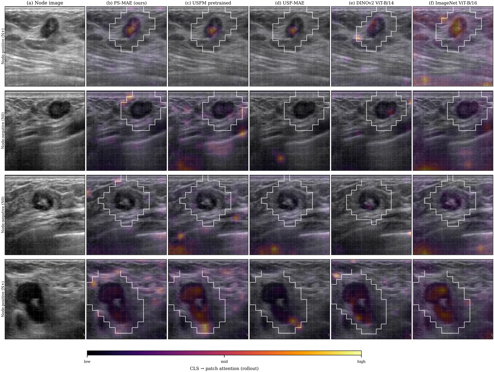 Attention rollout heatmaps for four node-positive and node-negative cases, comparing PS-MAE against USFM pretrained, USF-MAE, DINOv2, and an ImageNet-pretrained ViT, with the peritumoral ring outlined in white.