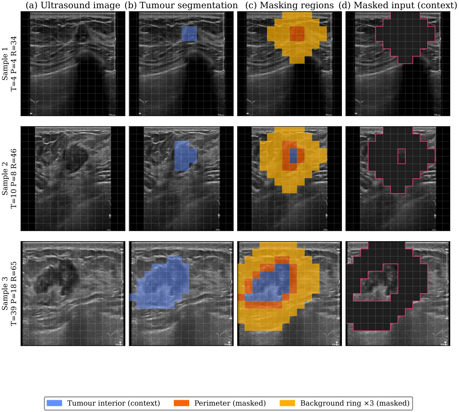 Four columns per sample: the original ultrasound image, the tumour segmentation, the derived masking regions (tumour interior, perimeter, and background ring), and the resulting masked input.